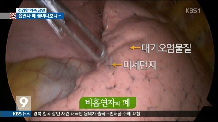 혐오주의) 흡연자의 폐 | 인스티즈