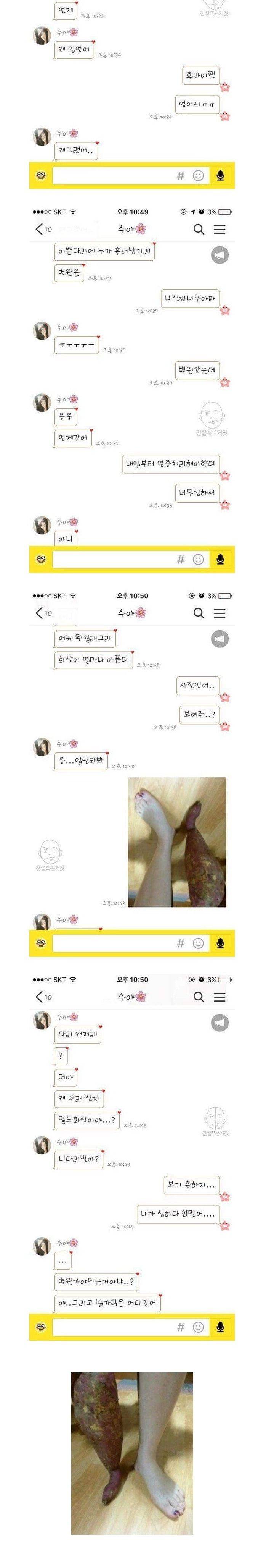 남친한테 화상입었다고 거짓말을 해봤다 | 인스티즈