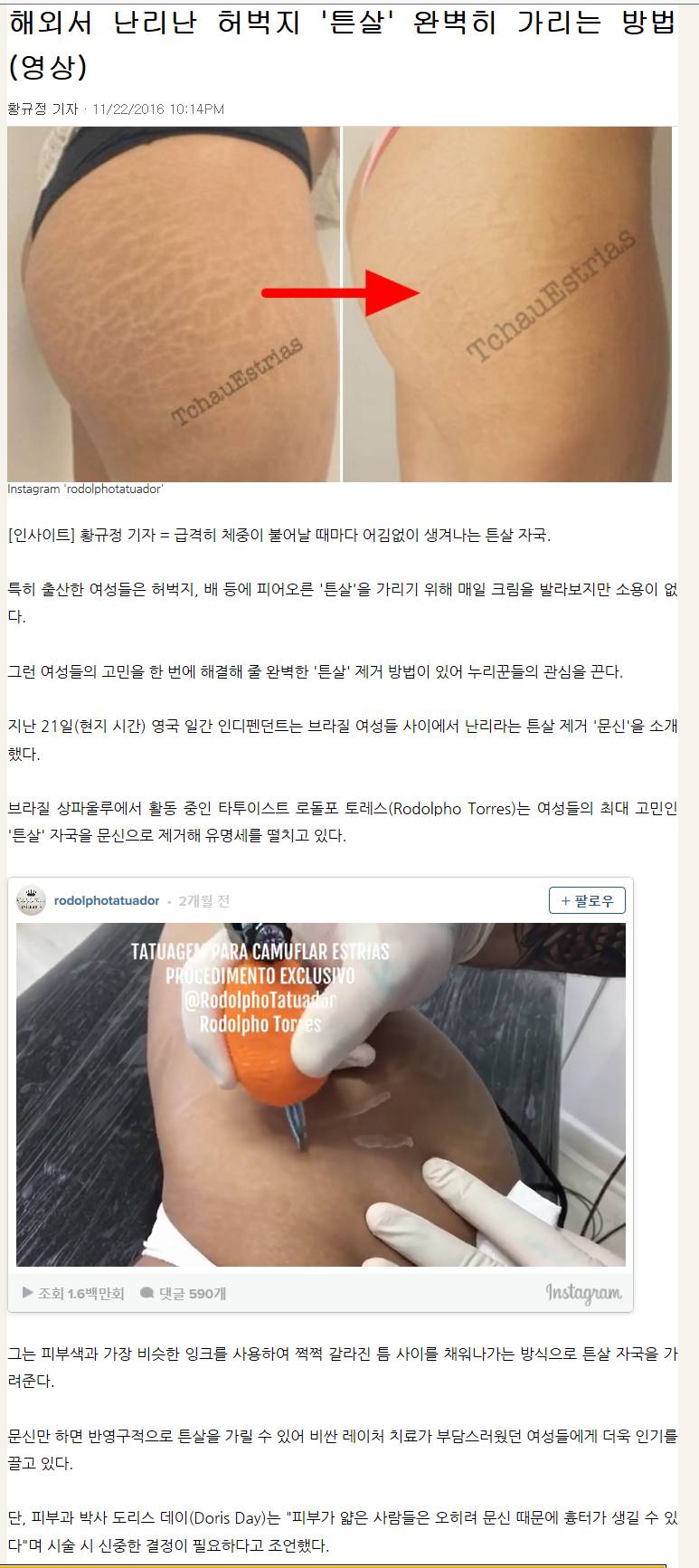 해외서 난리난 튼살 가리는 문신 개발~! | 인스티즈