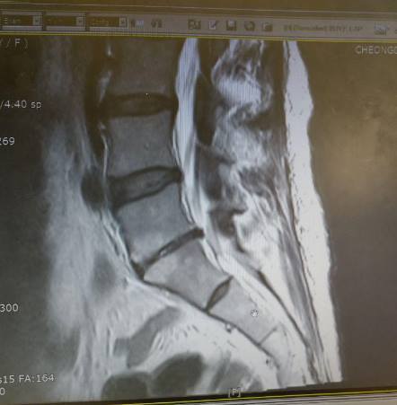 이상호 기자 페이스북(요추 추간판 퇴행 협착증 잘 아시는 분들 봐주세요).jpg | 인스티즈