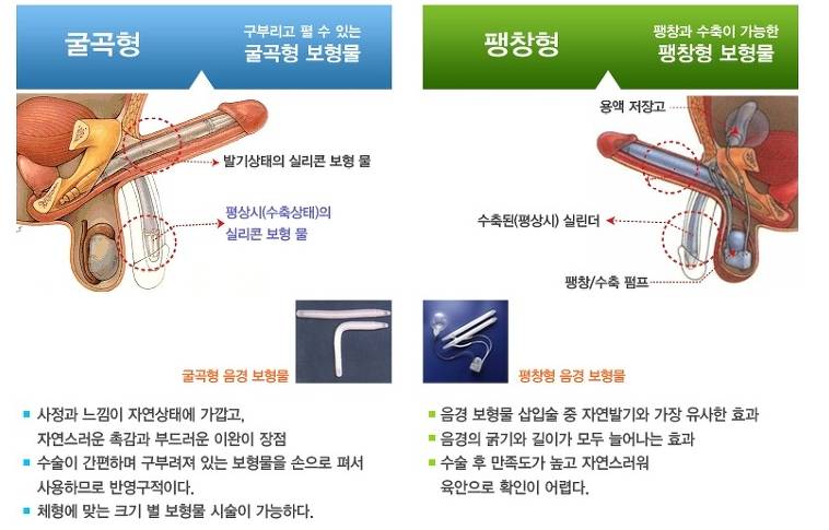 아래글에 여성시술 보고 놀라는 분들 ㅋㅋㅋ남자도 깜짝 놀랄 시술있어요... | 인스티즈