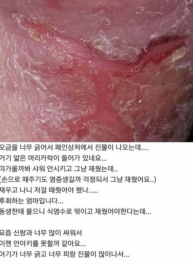 아기 약 안먹이고 자연 치유 시키는 안아키 라는 카페 (혐오주의) | 인스티즈