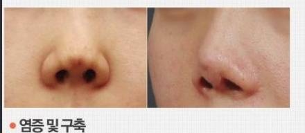 사람들은 잘 모를 수 있는 가장 위험한 성형수술 중 하나 | 인스티즈