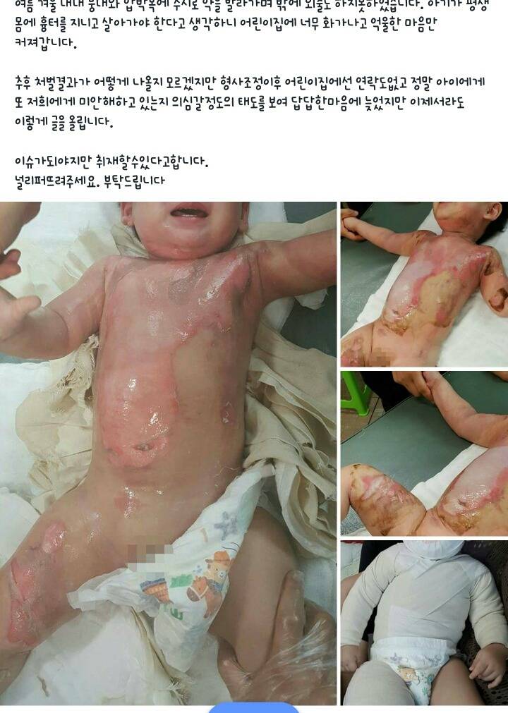 이슈화 되어야만 하는 시흥 어린이집 화상 사건 | 인스티즈