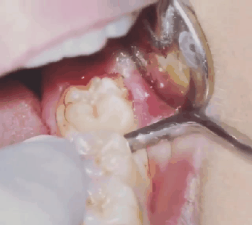 사랑니 발치.gif (혐오주의) | 인스티즈