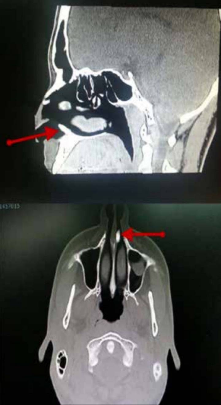 코에서 치아가 자라난 남성 | 인스티즈