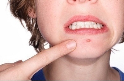 여드름 가장 짜증나는 위치는? | 인스티즈