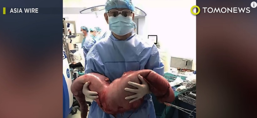 혐오주의) 변비걸린 남성의 장을 절제해보니 무게가 13kg... | 인스티즈