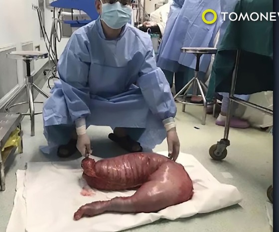 혐오주의) 변비걸린 남성의 장을 절제해보니 무게가 13kg... | 인스티즈