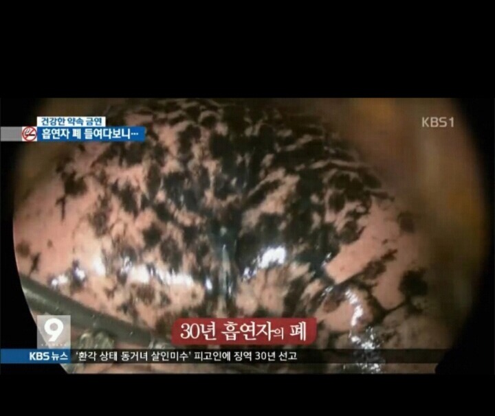 흡연자의 폐 . jpg | 인스티즈