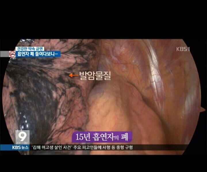 흡연자의 폐 . jpg | 인스티즈
