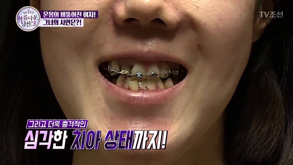 부정교합을 방치하면 안되는 이유 | 인스티즈