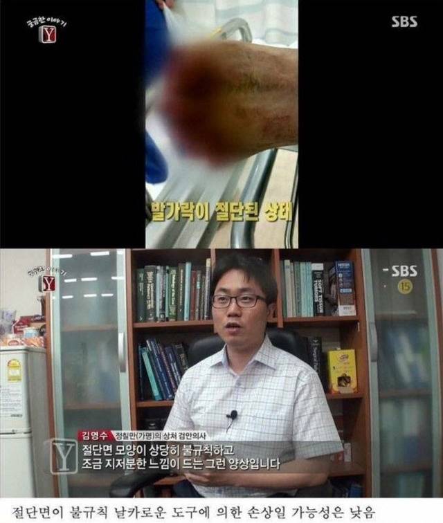 자고 일어나니 발가락이 모두 사라진 남자 | 인스티즈