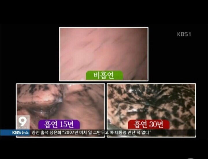 흡연자의 폐 . jpg | 인스티즈