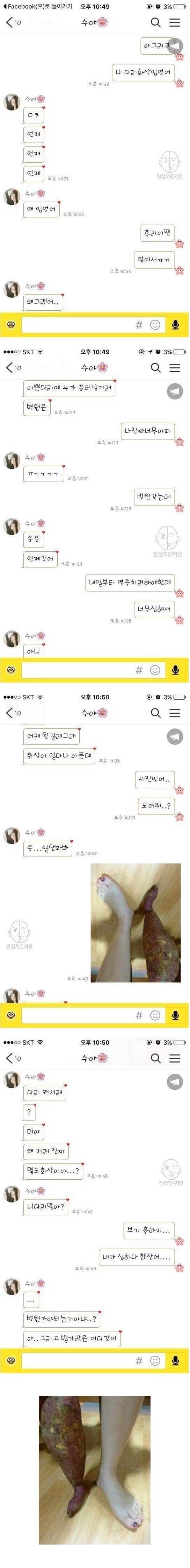 남자친구에게 화상 입었다고 거짓말을 해봤다 . jpg | 인스티즈