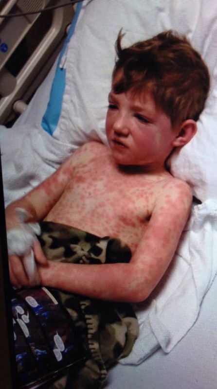 모든약으로 걸릴수있는 스티븐존슨 증후군 (난감) | 인스티즈