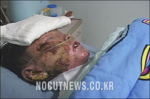 모든약으로 걸릴수있는 스티븐존슨 증후군 (난감) | 인스티즈