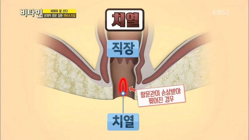 [비타민] ioi 최유정이 혈변을 보는 이유 ㅜㅜ.jpg | 인스티즈