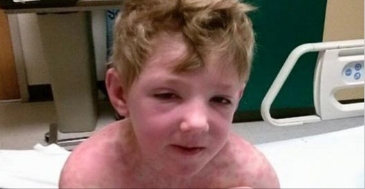 모든약으로 걸릴수있는 스티븐존슨 증후군 (난감) | 인스티즈