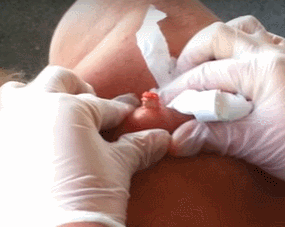 등 30년된 고름 짜기.gif (혐오주의) | 인스티즈