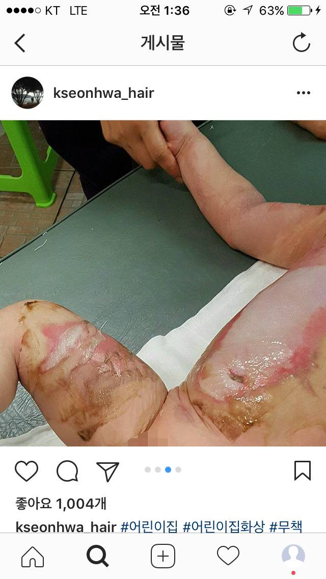 화상 입은 애기 나몰라라 하는 어린이집 | 인스티즈