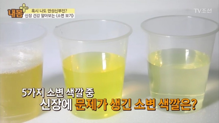 소변 색으로 보는 신장 건강 | 인스티즈