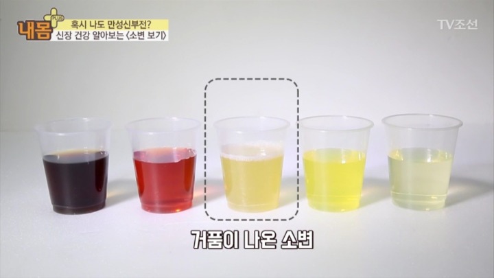 소변 색으로 보는 신장 건강 | 인스티즈