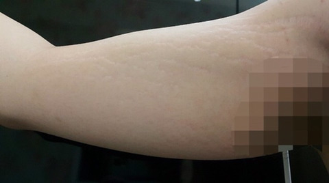 은근 신경쓰이는 튼살 | 인스티즈