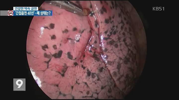 혐오주의) 담배를 끊어야 하는 이유 | 인스티즈