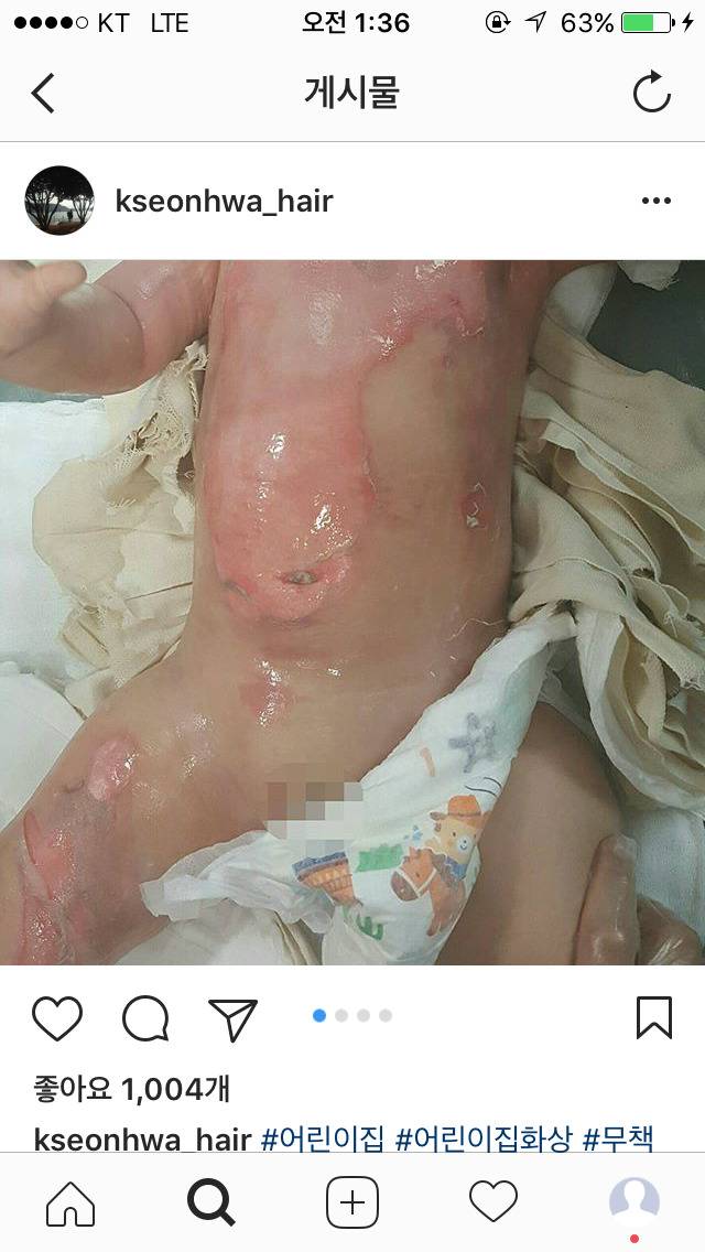 화상 입은 애기 나몰라라 하는 어린이집 | 인스티즈