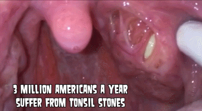 입냄새의 근원 편도결석 빼기.gif (혐오주의) | 인스티즈