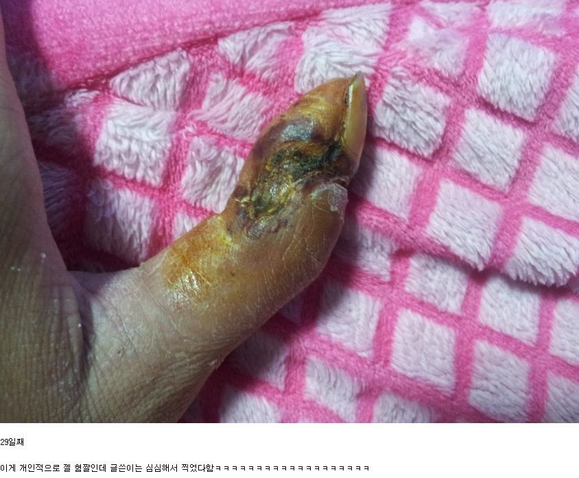 살모사에 물린 손가락 치유과정 (혐오주의) | 인스티즈