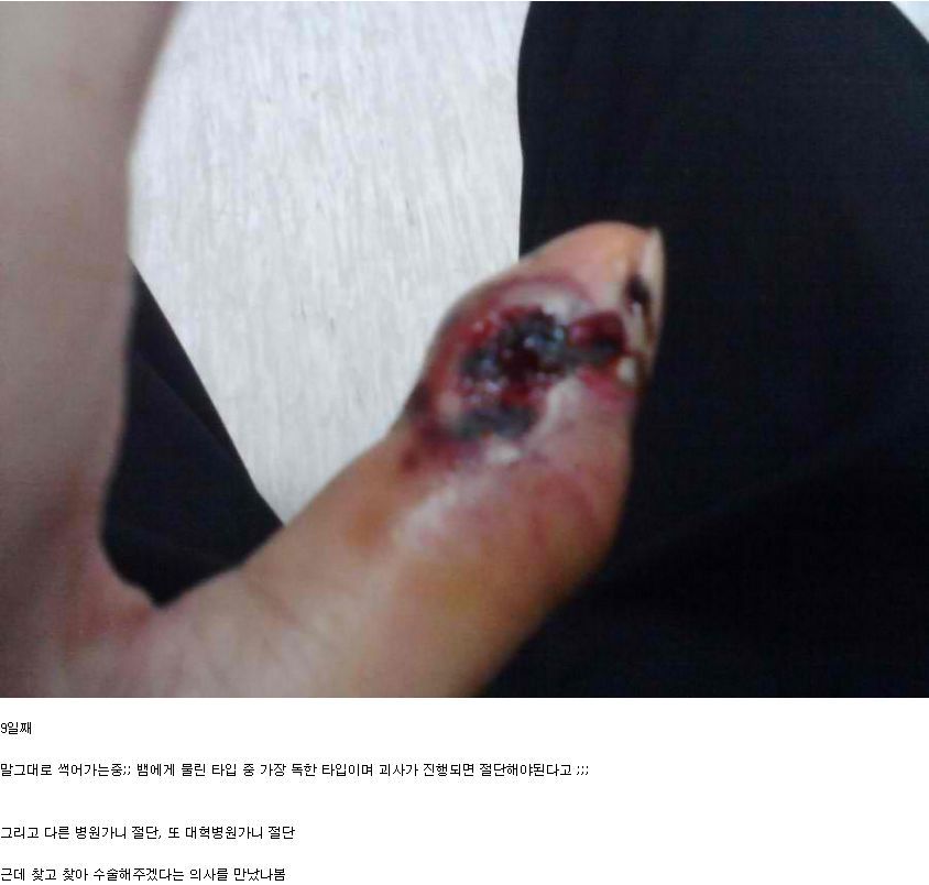 살모사에 물린 손가락 치유과정 (혐오주의) | 인스티즈