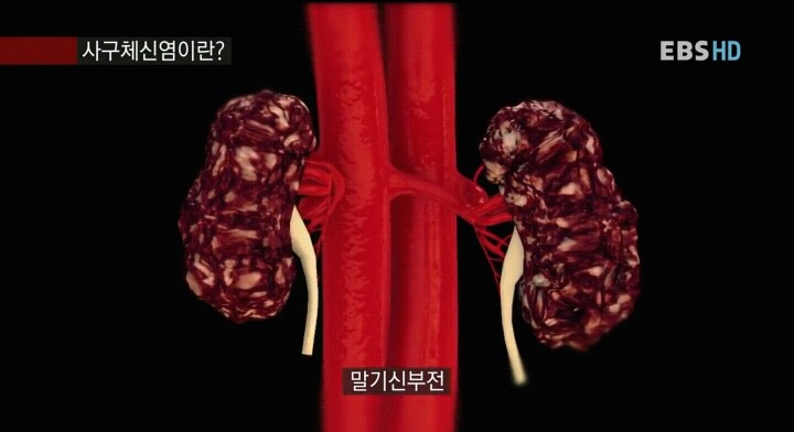 신장병을 초기에 아는 것은 아주 중요하다.jpg | 인스티즈