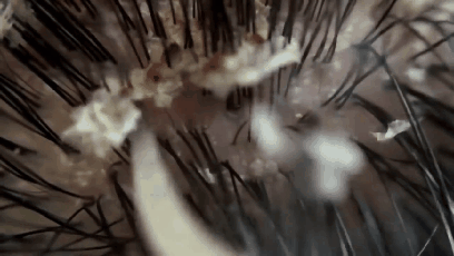 혐주의)비듬제거.GIF | 인스티즈