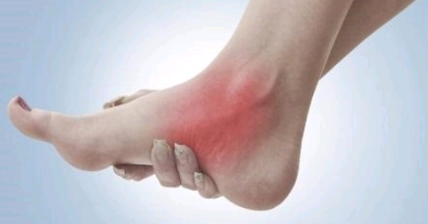 혹시 복사뼈밑에 뼈가 하나 더 튀어나와있어? 그거슨 -부주상골 증후군 | 인스티즈