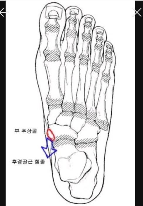 혹시 복사뼈밑에 뼈가 하나 더 튀어나와있어? 그거슨 -부주상골 증후군 | 인스티즈