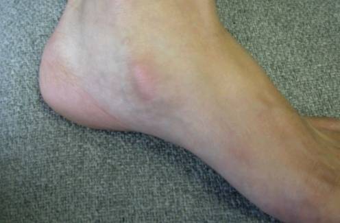 혹시 복사뼈밑에 뼈가 하나 더 튀어나와있어? 그거슨 -부주상골 증후군 | 인스티즈