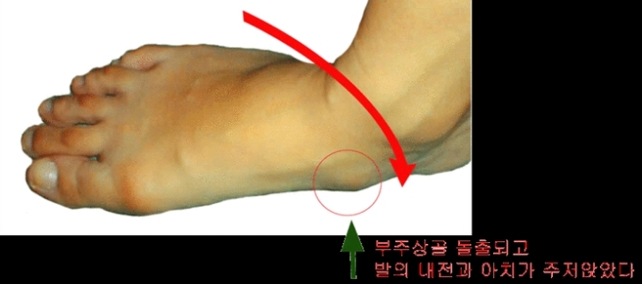 혹시 복사뼈밑에 뼈가 하나 더 튀어나와있어? 그거슨 -부주상골 증후군 | 인스티즈