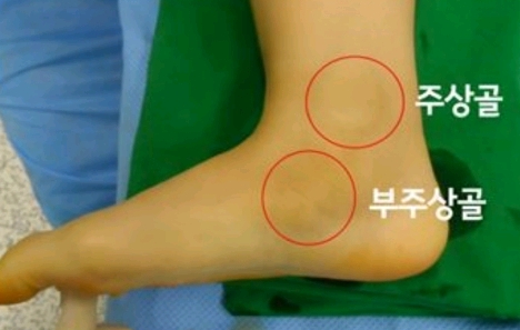 혹시 복사뼈밑에 뼈가 하나 더 튀어나와있어? 그거슨 -부주상골 증후군 | 인스티즈