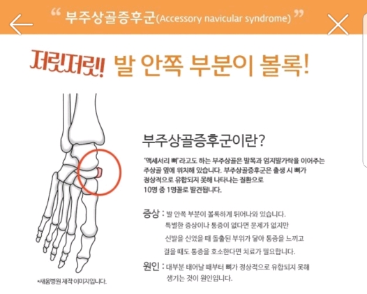 혹시 복사뼈밑에 뼈가 하나 더 튀어나와있어? 그거슨 -부주상골 증후군 | 인스티즈