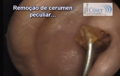 엄청 큰 귀지 (주의하세요) | 인스티즈