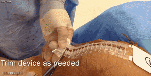 케이블 타이 원리의 상처 봉합술.gif | 인스티즈