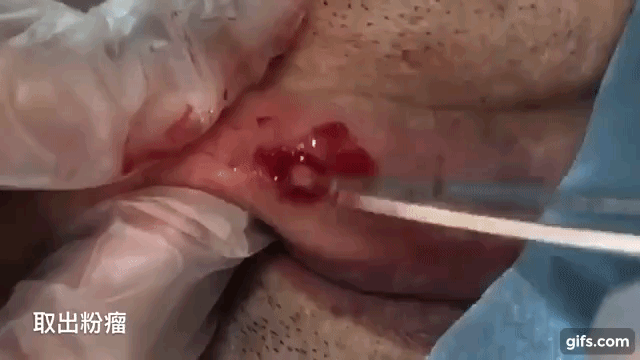 혐주의) 피지낭종 제거 | 인스티즈