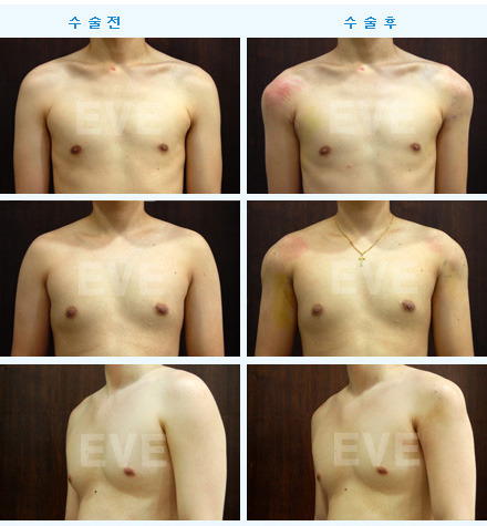 남자 어깨성형.jpg | 인스티즈