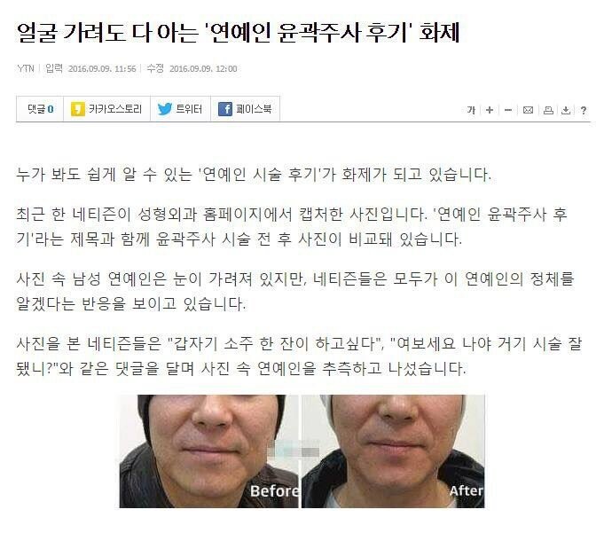 얼굴 가려도 다 아는 '연예인 윤곽주사 후기' 화제 | 인스티즈