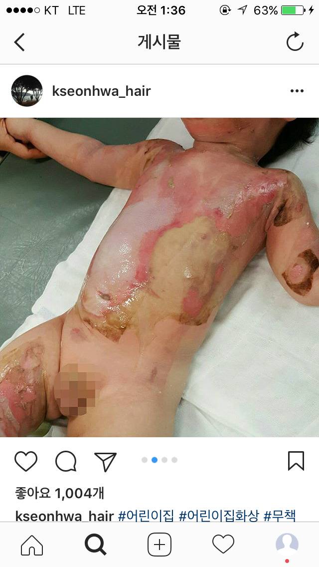 화상 입은 애기 나몰라라 하는 어린이집 | 인스티즈