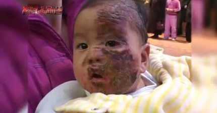 끓는 기름에 아기 얼굴이 빠졌는데 병원으로 안 가고 교회(사이비)에 기도하러 간 부모 (아가 화상입은 얼굴 있어ㅠㅠ) | 인스티즈