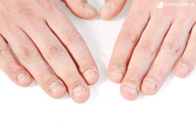 손톱 깎을 때 바짝 깎기 vs 흰 부분 남겨두기 | 인스티즈
