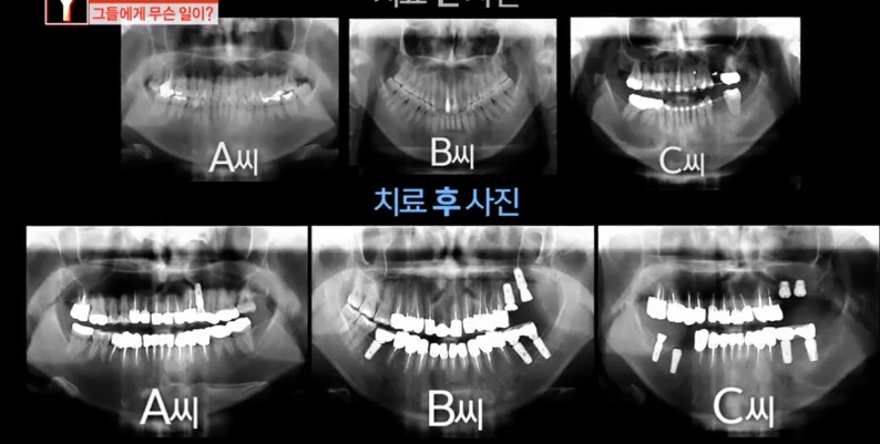 [궁금한이야기] 같은 치과 의사들도 충격받았다는 진료사진.jpg | 인스티즈